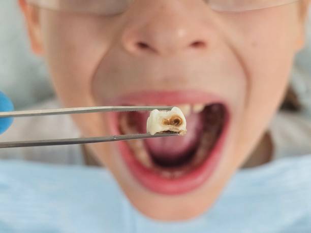Best Knocked-Out Tooth (Avulsed Tooth) Treatment in Country Club Hills, MO